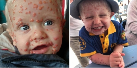 Oscar est couvert de boutons et sa maman croit qu’il a la varicelle mais le médecin a un autre diagnostic